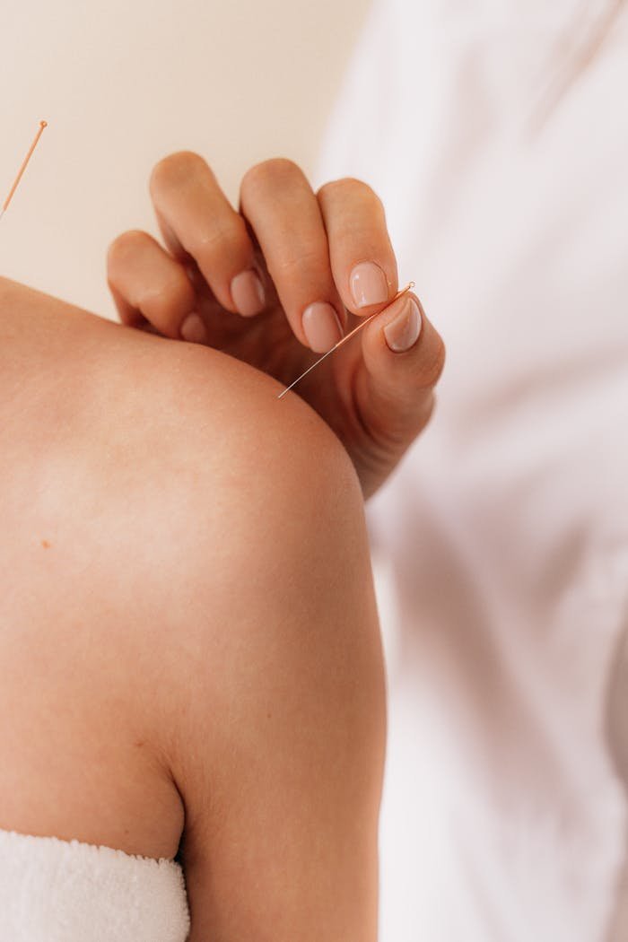 Close-up of acupuncture needle therapy on a patients shoulder illustrating alternative medicine.